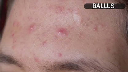 ✨ ClearSkin Pro™ Blackhead Remover Vacuum – Deep Pore Cleaning in Seconds ✨